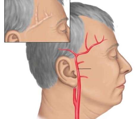 Болит голова слева у виска отдает в глаз