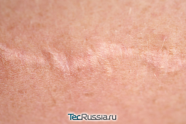 хорошо заживший нормотрофический рубец