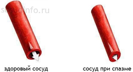 Болит голова спазмы сосудов