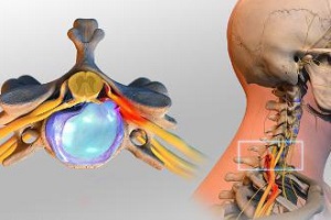От грыжи позвоночника болит голова