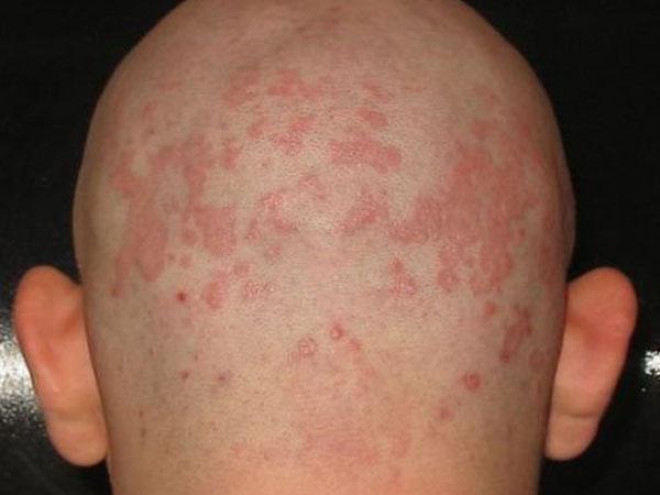 На голове появились красные пятна и болят