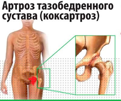 Артроз тазобедренного сустава