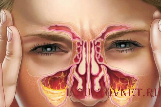 Головная боль при гайморите