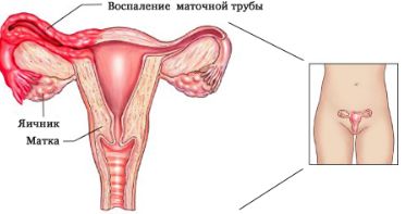 почему болит спина после месячных как при месячных