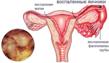 почему болит спина после месячных как при месячных
