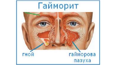 Болит спина в районе поясницы и температура