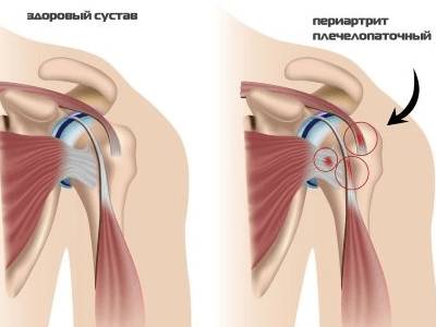 Рука болит левое боль в шее в спине