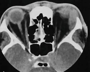 Болит спина в районе поясницы и температура