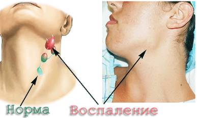 Болит спина в районе поясницы и температура