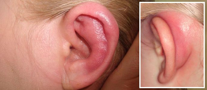 Закладывает уши и болит голова при патологиях слухового анализатора