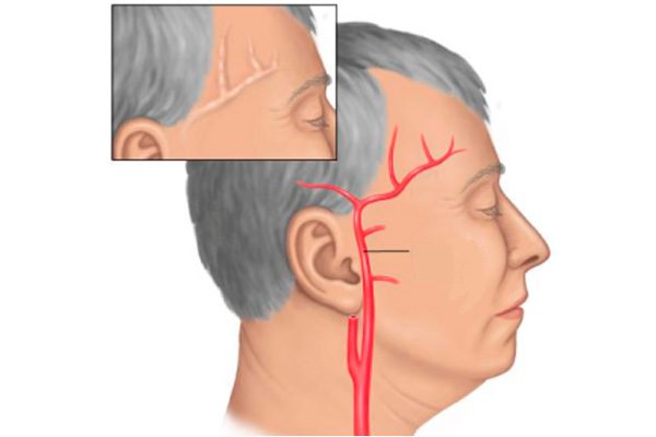 Голова болит второй день помогает только таблетка