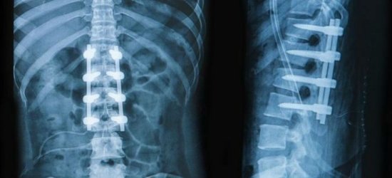 Рентген позвоночника