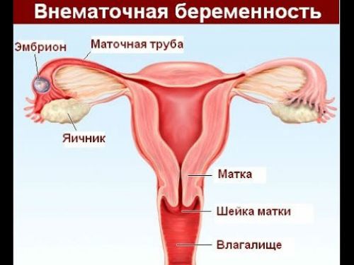 Внематочная беременность