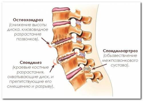Дегенеративно-дистрофические заболевания позвоночника Дегенеративно-дистрофические заболевания позвоночника
