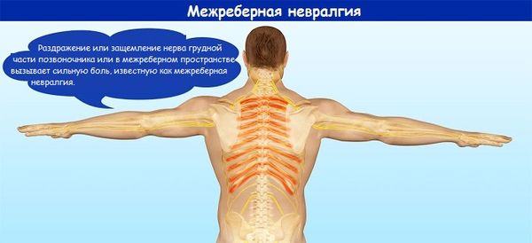 Межреберная невралгия