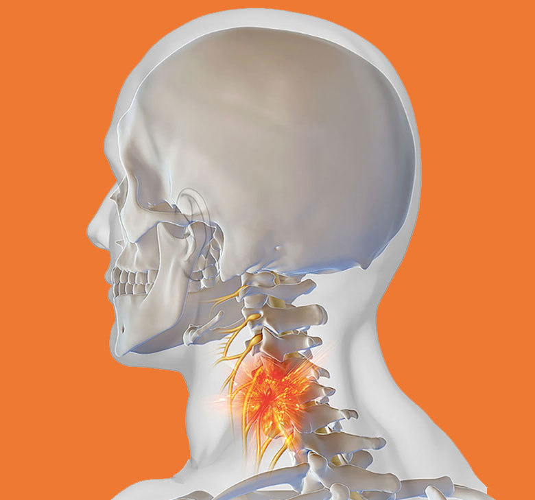Остеохондроз: Что делать, если болят шея и голова Остеохондроз: Что делать, если болят шея и голова