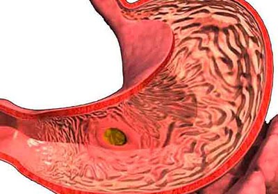 Крутит желудок и болит голова