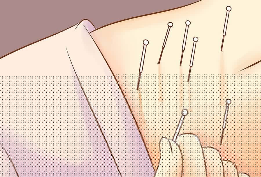 Иглорефлексотерапия