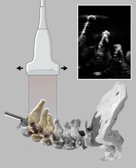 Иллюстрация показывает, как ультразвуковой луч отражается от костных поверхностей нижних шейных позвонков
