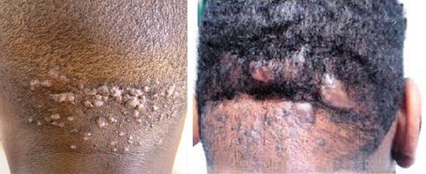 Келлоидные акне на затылке