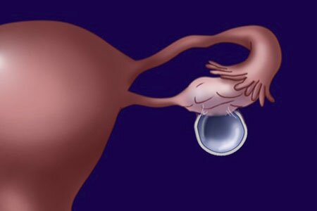 Новообразование на придатке Новообразование на придатке