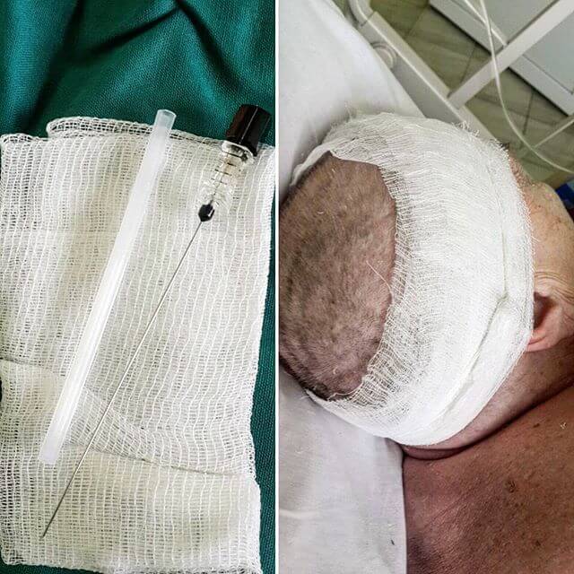 Люмбальная пункция для выведения спиномозговой жидкости (ликвора) Люмбальная пункция