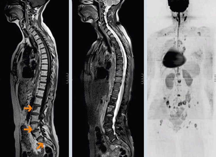 МРТ позвоночника