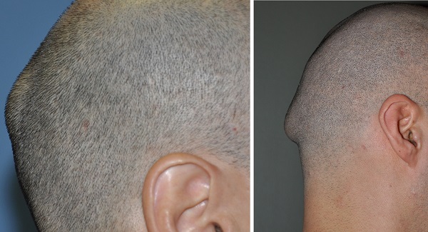 Остеома на затылке