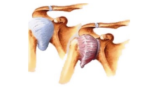 Плечелопаточный периартрит Плечелопаточный периартрит