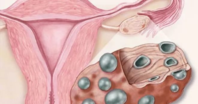 Поликистоз яичников – как выявить и вылечить недуг, чтобы забеременеть?