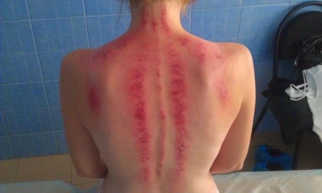 Синяки после массажа