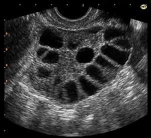 почему болит спина после месячных как при месячных