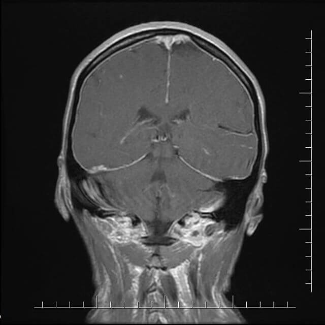 Внутричерепная гипотензия