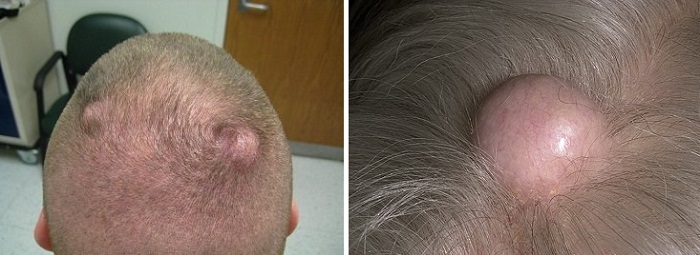 Волосяная киста на затылке