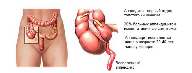 Воспаленный аппендикс