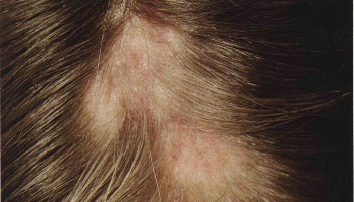 болит и чешется кожа головы при прикосновении