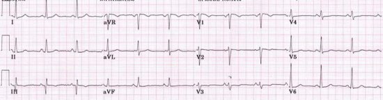 Инфаркт на ЭКГ
